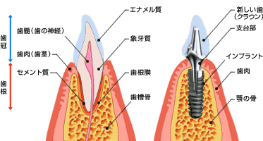 インプラントって何？