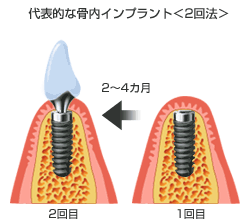 代表的な骨内インプラント（2回法）