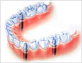 インプラントに固定式のブリッジが可能