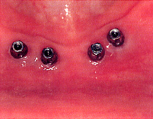 インプラント4本を埋入