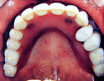 インプラントを支えに部分入れ歯を装着