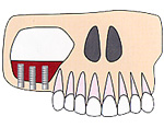 上顎洞に移植骨や骨補填材で補充