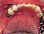 インプラント治療前、ブリッジをはずしたところ